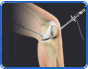 Cartilage Repair and Restoration - Alexander Golant, MD - Orthopedic Surgeon